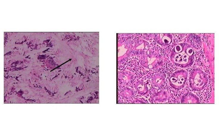 Đi chân đất, dùng corticoid tùy tiện: Nguy cơ giun lươn gây biến chứng nguy hiểm
