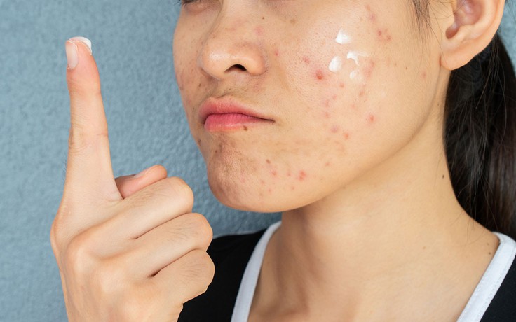 Da vùng má dễ bị thâm mụn? Cách chăm sóc da giúp da đều màu hơn