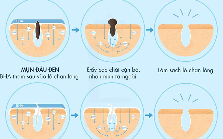 Da mụn nên dùng BHA hay AHA - phương pháp chăm da mụn chuẩn khoa học