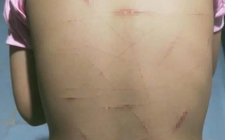 Vụ học sinh lớp 5 ở Cà Mau nghi bị bạo hành: Công an báo cáo vụ việc ban đầu như thế nào?