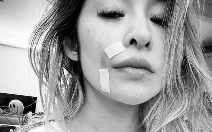 Diva Đài Loan Tiêu Á Hiên biến dạng gương mặt sau khi bị chó tấn công