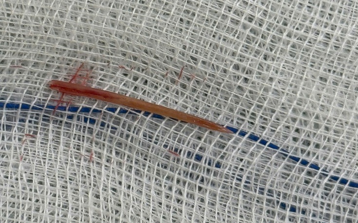 Đau bụng 5 ngày, đi khám phát hiện xương cá đâm xuyên ruột non