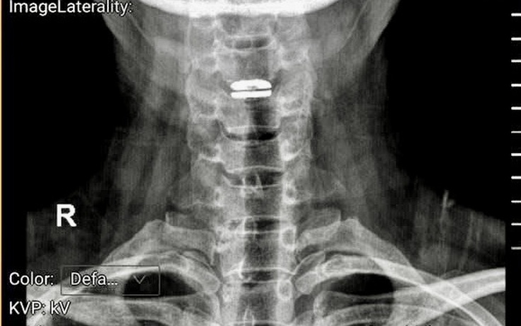 Sai lầm khi trị đau cổ vai gáy có thể gây liệt