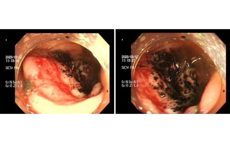 Đau bụng tưởng bình thường, nhiều người trẻ mắc ung thư đại trực tràng giai đoạn muộn