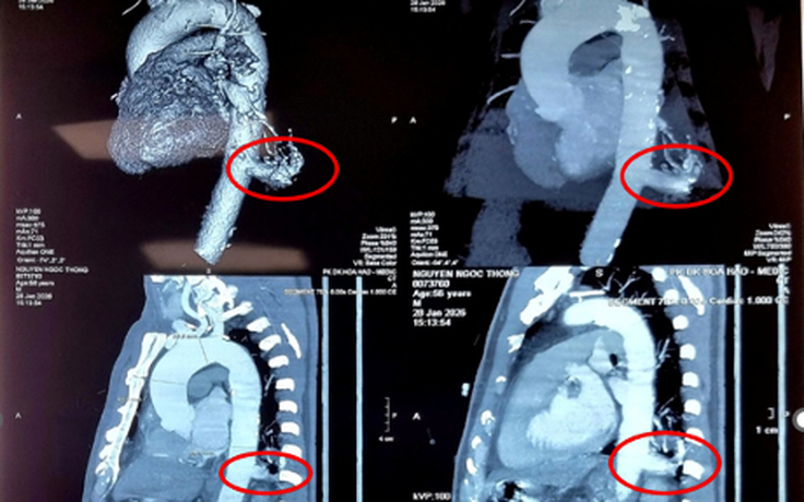 Việt Nam lần đầu dùng robot mổ điều trị phổi biệt lập thành công