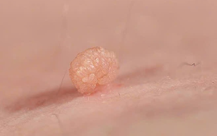 Tình dục không an toàn, nam bệnh nhân gần 70 tuổi mắc sùi mào gà