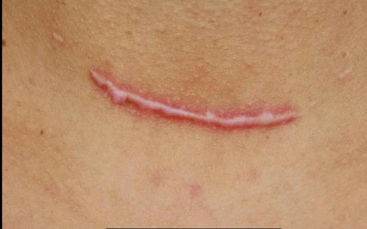 Áp lực cơ học và tăng sinh collagen: Góc nhìn mới trong phòng ngừa sẹo hậu phẫu