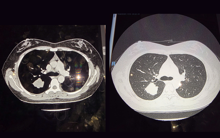 ‘Mắt thần’ trong tầm soát ung thư phổi: Một nốt mờ nhỏ thay đổi tiên lượng sống