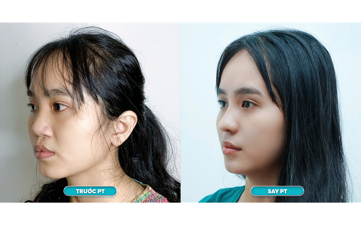 Bệnh viện JK Nhật Hàn miễn phí phẫu thuật 20 case mũi