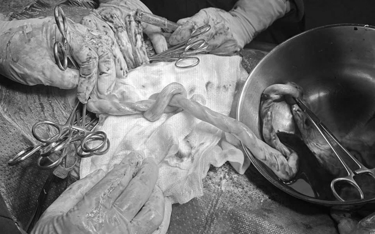 Thắt nút dây rốn, thai nhi nguy cơ tử vong rất cao