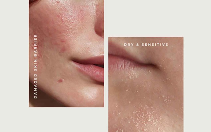 Da yếu là gì? Dấu hiệu và cách phục hồi hiệu quả trong 4 tuần