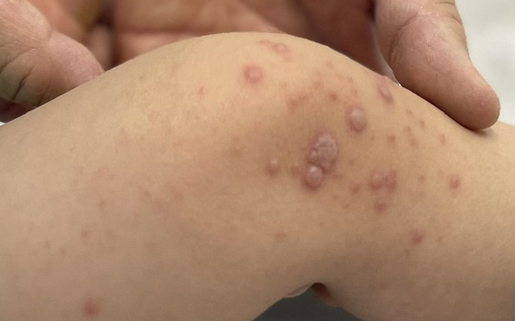 Việt Nam chờ vắc xin tay chân miệng nhập về hạ nhiệt dịch