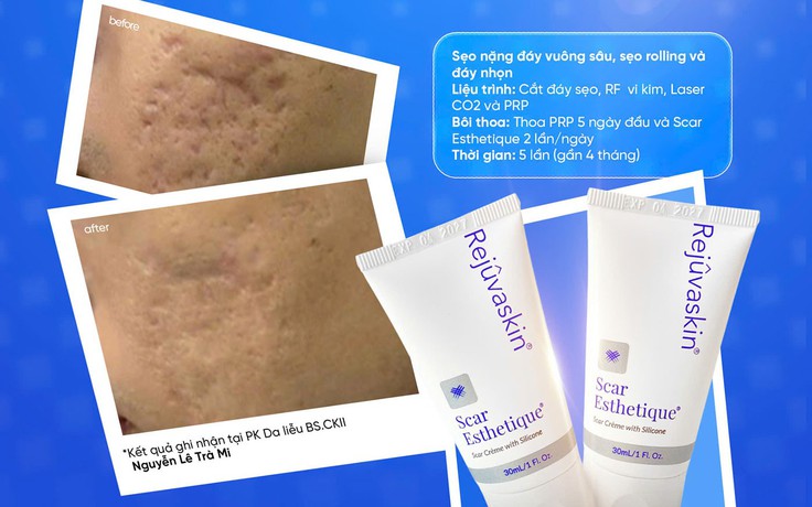 Cách mờ sẹo mụn sau laser: Giảm viêm, hỗ trợ lành thương và tái tạo thể tích