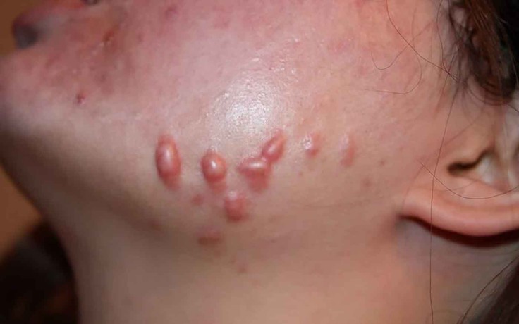 Chuyên gia Rejuvaskin bật mí cách mờ sẹo lồi do mụn hiệu quả theo đúng giai đoạn