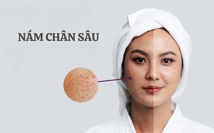 Top 5 kem mờ nám 'đắt tiền đến mấy' cũng mua vì hiệu quả nám chân sâu
