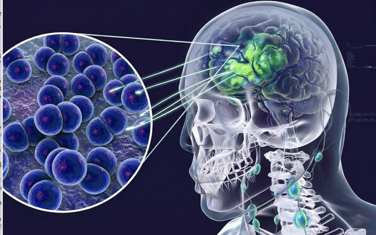 Cà Mau: 3 ca nghi viêm não mô cầu, 2 ca dương tính, 1 ca tử vong