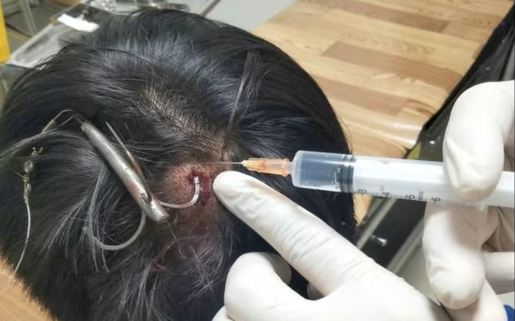 Móc câu 3 tiêu găm vào đầu khi câu cá, thiếu niên 15 tuổi nhập viện