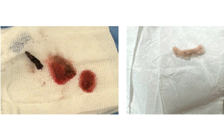 Ho ra máu, bé 3 tuổi nhập viện: Nguyên nhân từ dị vật dài 2 cm