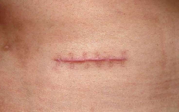 Định nghĩa lại phục hồi hậu phẫu: Từ ‘liền thương’ đến ‘liền thương có kiểm soát’