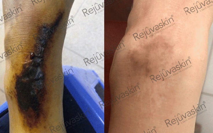 Sẹo phì đại ở khớp: nguyên nhân, nguy cơ và hướng điều trị sớm