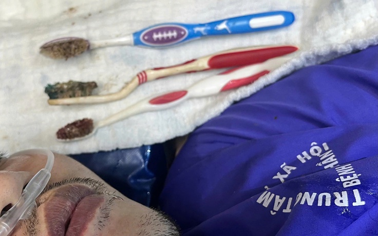 Nuốt 3 bàn chải đánh răng dài 20 cm, nam thanh niên nhập viện nguy kịch