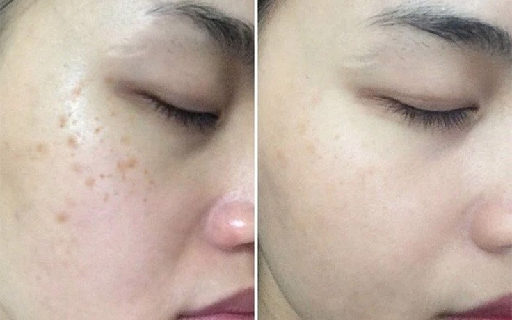 Top 5 serum giúp ‘tạm biệt’ nám, thậm chí nám hỗn hợp tưởng như chưa tồn tại
