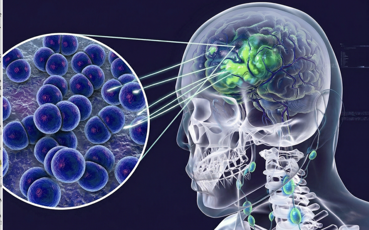 Viêm não mô cầu: Sau ca tử vong, 10 ngày qua Cà Mau chưa có ca mới