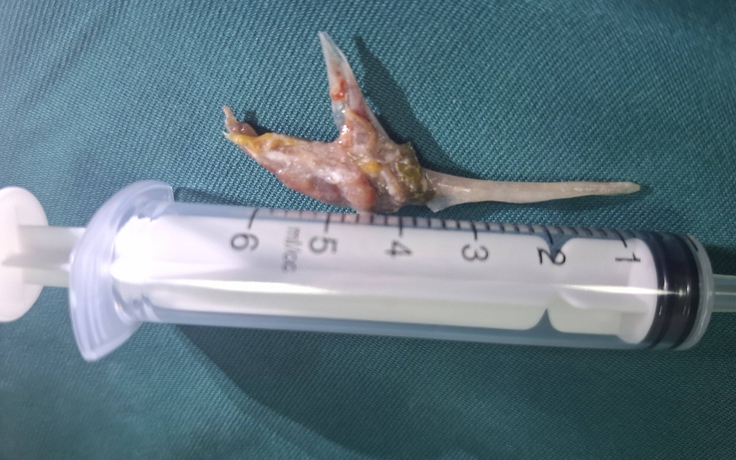 Nuốt đinh, hóc xương, rơi răng giả: Những ca cấp cứu khiến bác sĩ toát mồ hôi