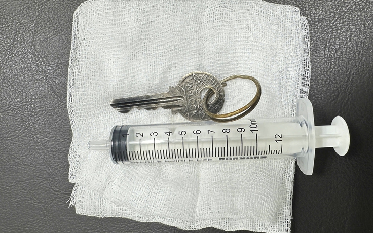 Nội soi, gắp chiếc chìa khóa cửa trong dạ dày bệnh nhi 14 tuổi