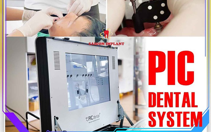 PIC Dental và Face Scan 3D - Tiêu chuẩn vàng cho phục hình Implant toàn hàm