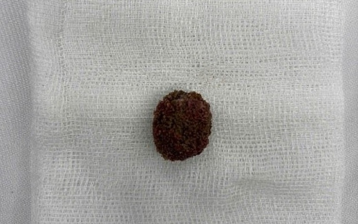 TP.HCM: Tin 'thuốc tan sỏi thận' trên mạng, người đàn ông tắc nghẽn đường niệu