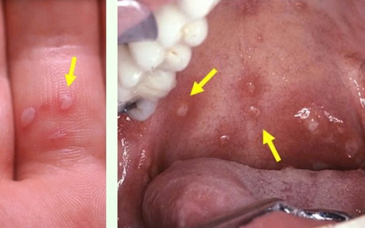 TP.HCM: Biến thể mới gây tay chân miệng nguy hiểm thế nào?
