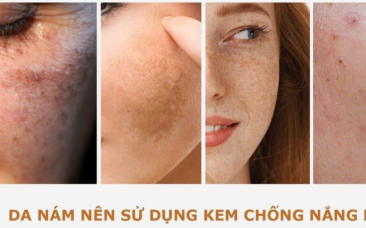 Nám tái đi tái lại do chưa ‘update’ 3 kem chống nắng cho da nám dưới đây!