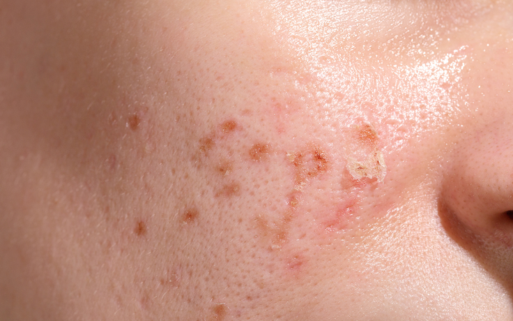 Cùng một liệu trình, vì sao kết quả điều trị sẹo rỗ lại khác biệt?