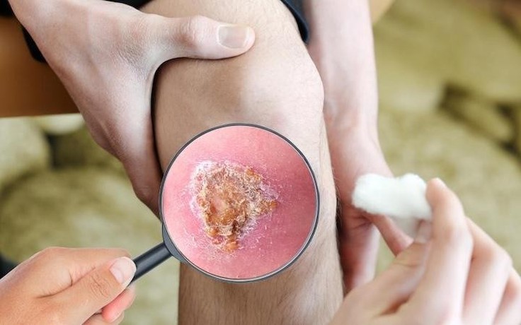 Giải mã ‘cuộc chiến’ vi mô tại vết thương: Khi sự kiểm soát quyết định phục hồi