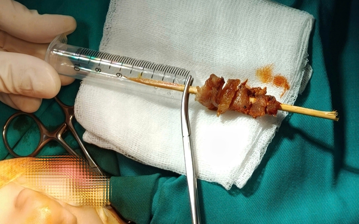 Cấp cứu bé gái 2 tuổi rưỡi bị que xiên thịt đâm sâu đến hốc mắt