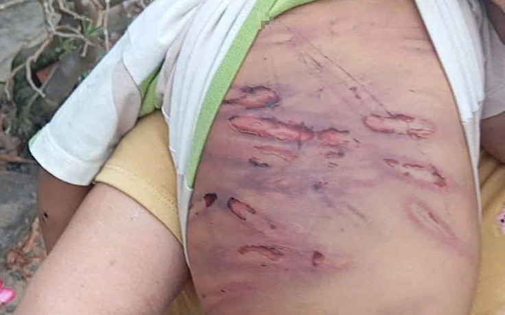 Tạm giữ mẹ ruột và người tình hành hạ bé trai 2 tuổi hôn mê, gãy xương