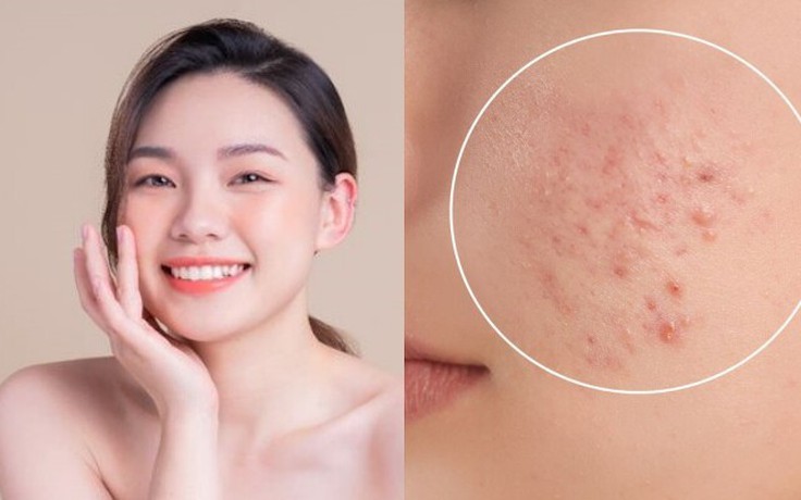 Hết tình trạng bí da mùa hè: Sản phẩm phục hồi này đang gây sốt khắp TikTok