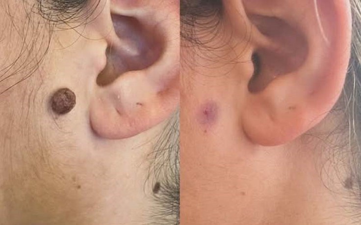 Sẹo thâm do tẩy nốt ruồi mãi không hết: Chuyên gia nói gì về cách cải thiện?