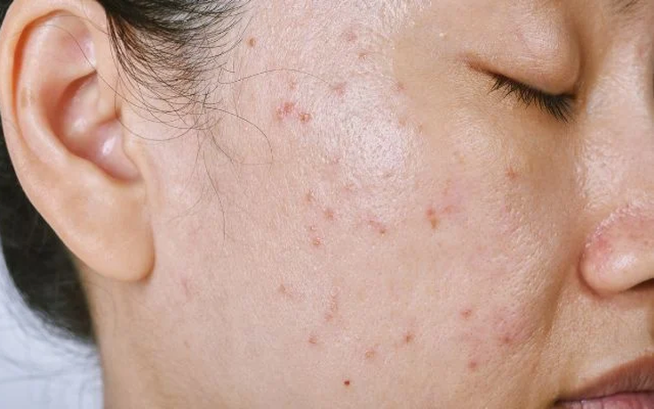 Sữa rửa mặt nên có trong routine da dầu mụn của Trioderma?
