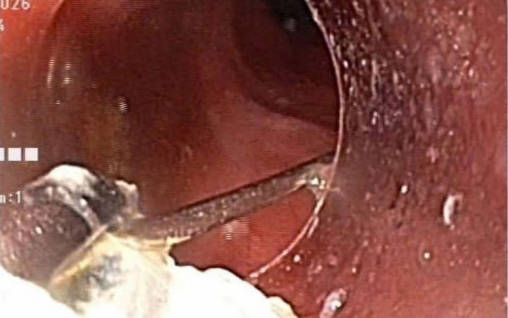 Nội soi lấy chiếc ghim nhọn 3 cm trong dạ dày bé 10 tuổi
