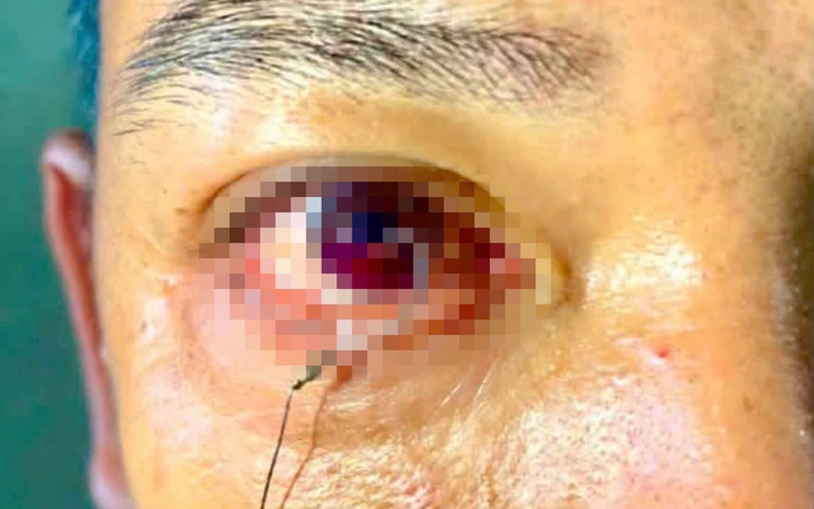 Cấp cứu bệnh nhân bị lưỡi câu ghim vào mắt