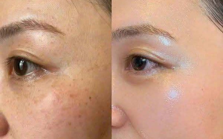 +5 serum mờ nám hỗn hợp, kể cả nám lâu năm cũng cải thiện nhanh chóng