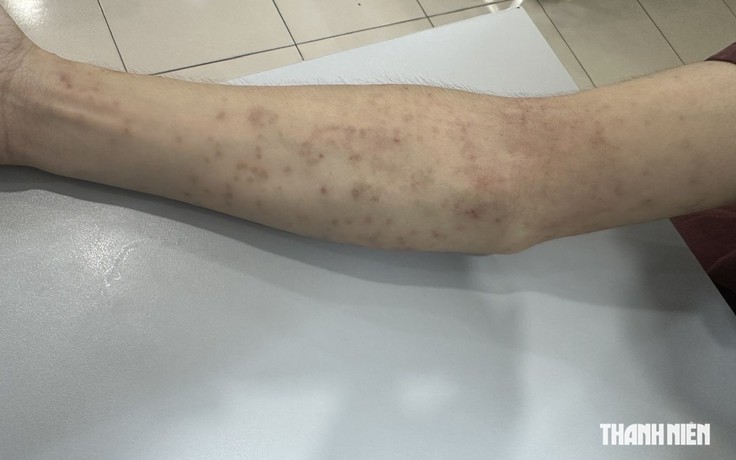 Trị tận gốc viêm da mùa nắng nóng
