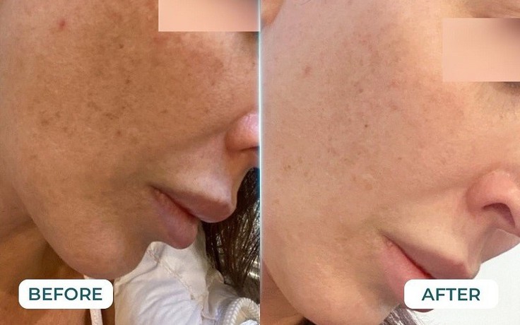 Top 7 kem mờ nám chân sâu giúp da trắng hồng rạng rỡ sau khoảng 4 tuần