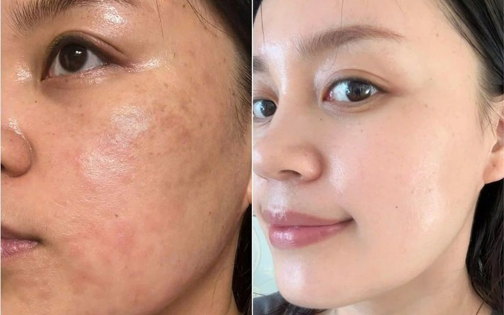 Da dầu mụn mùa nắng nóng ‘mê mẩn’ sản phẩm phục hồi này vì không bí da