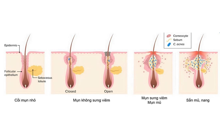 Gel chấm mụn nên dùng khi nào? Những lưu ý trước khi chấm mụn