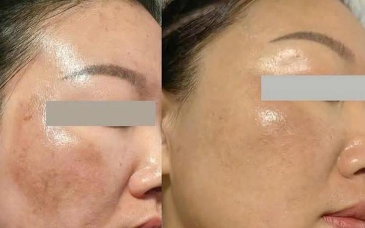 +5 serum mờ nám mảng loang lổ khắp mặt cũng cải thiện, da bật tone trắng hồng