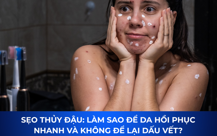 Sẹo thủy đậu có tự hết không? Cách mờ sẹo sau 4 tuần, kể cả lâu năm