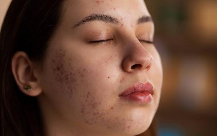 'Cứu' làn da nhiễm corticoid và tổn thương do peel, laser sai cách